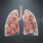 Emphysème pulmonaire : quand et comment cela influence réellement l'espérance de vie découvrez comment l'emphysème pulmonaire affecte l'espérance de vie, quand ses impacts deviennent significatifs, et quelles mesures peuvent améliorer la qualité et la durée de vie.